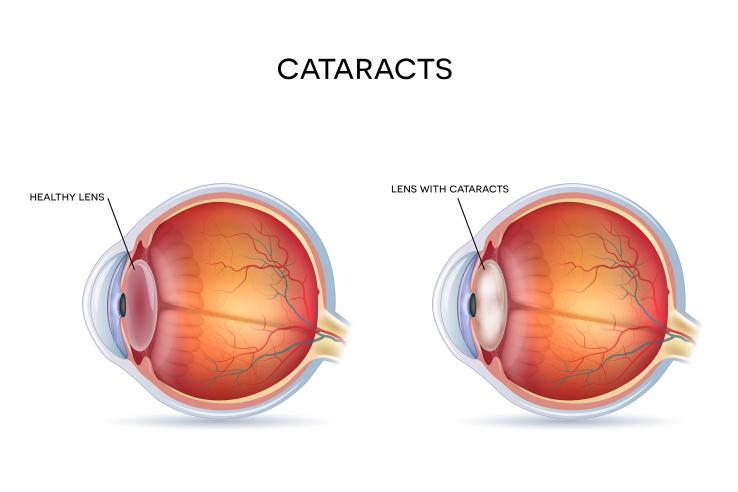Cataracts